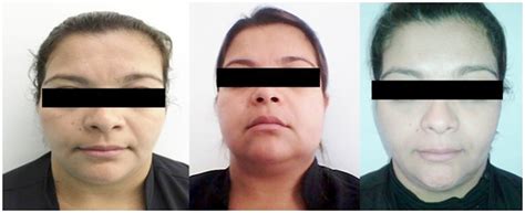 Bichat’s Buccal Fat Pad Removal: Cheek Reduction .